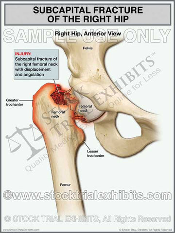 Hip Fracture - Subcapital Fracture of the Right Hip
