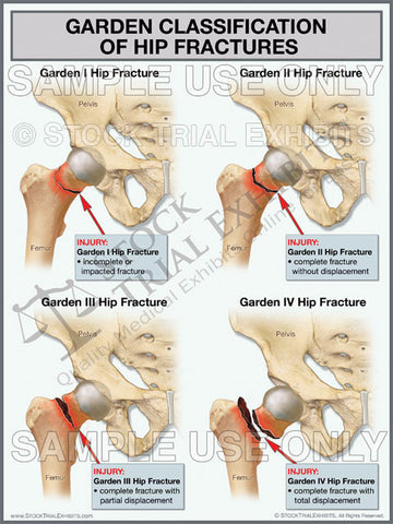 Hip Fractures Garden Classification Trial Exhibit