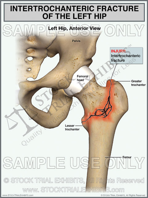 Intertrochanteric Fracture of the Left Hip