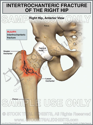 Intertrochanteric Fracture of the Right Hip