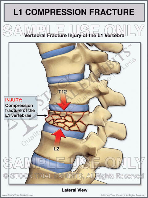 L1 Vertebra Compression Fracture Trial Exhibit – Stock Trial Exhibits