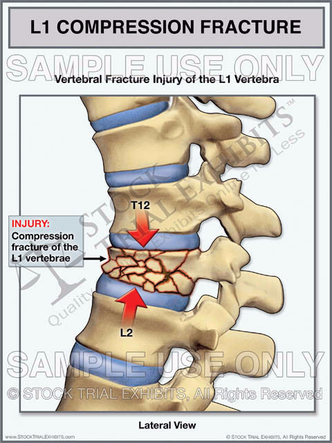 L1 Compression Fracture, This trial exhibit depicts an L1 vertebral compression fracture in an enlarged close up view, showing details of the vertebral fracture injury with compression of the vertebral body and shifting of the vertebral column resulting from the injury. A detailed medical illustration of the L1 compression fracture in the lateral view, with descriptive labels of anatomy and injury. 