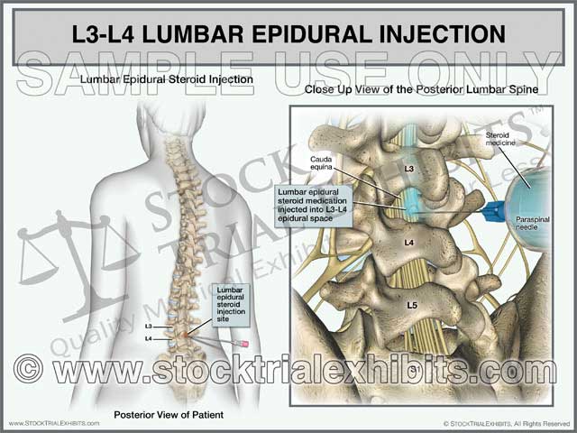 This medical exhibit depicts an L3-L4 lumbar epidural steroid injection on a female patient for pain management treatment of L3-L4 lumbar disc injury. The exhibit shows a transparent female figure orientation view of injection site location on the left, with a close up posterior view of the epidural steroid injection procedure with lumbar spine anatomy in detail on the right, with descriptive labels. 