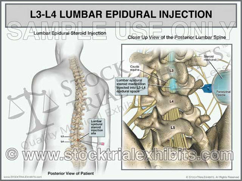 L3-L4 Epidural Injection of Lumbar Spine Trial Exhibit (Male)