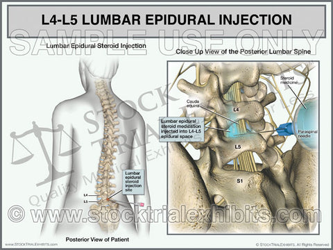 L4-L5 Epidural Injection of Lumbar Spine Trial Exhibit (Female)