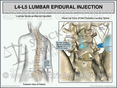 L4-L5 Epidural Injection Trial Exhibit. This medical exhibit shows L4-L5 lumbar epidural steroid injection on a female patient for pain management treatment of L4-L5 lumbar disc injury. L4-L5 Epidural Injection of Lumbar Spine Trial Exhibit (Female)