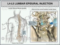 L4-L5-Lumbar-Epidural-Injection-Male_trial-exhibit, epidural injection L4-L5, Epidural steroid injection of lumbar spine L4-5, pain management injection of L4-5, lumbar steroid injection L4-L5 