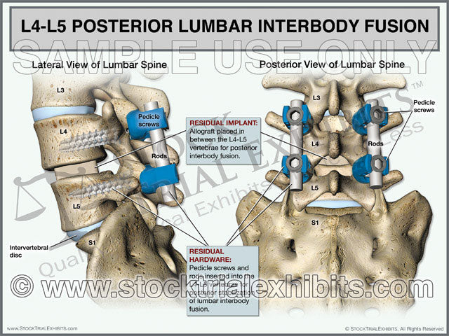 This trial exhibit graphically depicts L4-L5 Posterior Lumbar Interbody Fusion (PLIF), shown from the lateral and posterior views. The medical illustrations in this exhibit show the residual hardware of the pedicle screws and rods inserted into the lumbar spine vertebrae at the L4 and L5 levels. An intervertebral allograft is also shown placed for interbody fusion between the L4-L5 vertebrae, with descriptive labels of hardware and lumbar spine anatomy. 