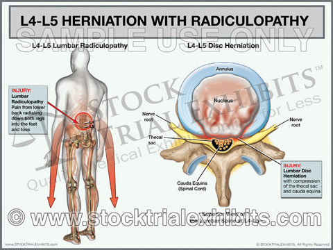 L4-L5 Herniation with Radiculopathy - Male