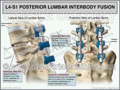 This trial exhibit graphically depicts L4-S1 Posterior Lumbar Interbody Fusion (PLIF), shown from the lateral and posterior views. The medical illustrations in this exhibit show the residual hardware of the pedicle screws and rods inserted into the lumbar spine vertebrae at the L4, L5 and S1 levels. An intervertebral allograft is also shown placed for interbody fusion between the L4-L5 and L5-S1 vertebrae, with descriptive labels of hardware and lumbar spine anatomy. 