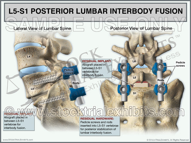Lumbar Fusion L5-S1 Stock medical illustration trial exhibit