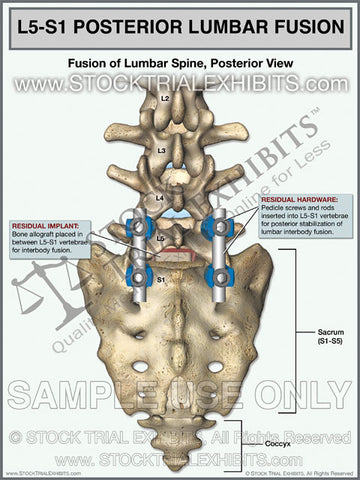 L5-S1 Lumbar Spine Fusion Posterior View