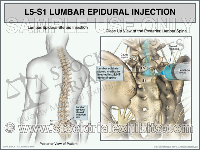 This medical exhibit depicts an L5-S1 lumbar epidural steroid injection on a male patient for pain management treatment of L5-S1 lumbar disc injury. The exhibit shows a transparent male figure orientation view on the left with a close up posterior view of the epidural steroid injection procedure with lumbar spine anatomy in detail on the right, with descriptive labels. 