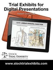 L4-L5 Epidural Injection High quality resolution trial exhibit, from www.stocktrialexhibits.com for instant download. L4-L5 Epidural Injection of Lumbar Spine Trial Exhibit (Female)