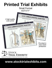 L4-L5 Epidural Injection of Lumbar Spine Trial Exhibit (Female) small format printed trial exhibits