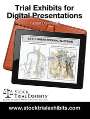 L4-L5 Epidural Injection High quality resolution trial exhibit