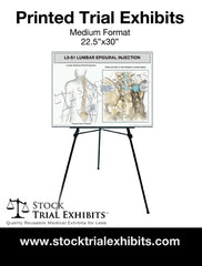 L4-L5 Epidural Injection of Lumbar Spine Trial Exhibit (Male)