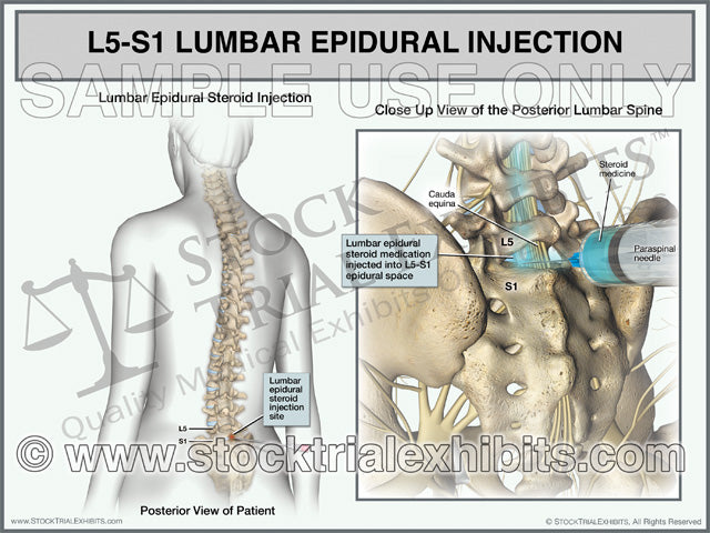 This medical exhibit depicts an L5-S1 lumbar epidural steroid injection on a female patient for pain management treatment of L5-S1 lumbar disc injury. The exhibit shows a transparent female figure orientation view on the left with a close up posterior view of the epidural steroid injection procedure with lumbar spine anatomy in detail on the right, with descriptive labels. 