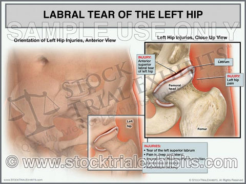 Labral Tear of the Left Hip