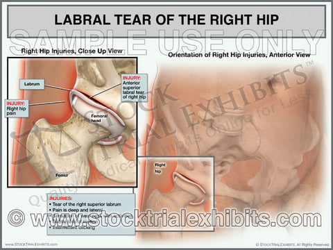 Labral Tear of the Right Hip