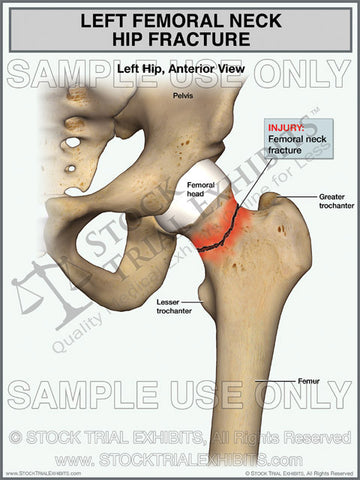Left Femoral Neck Hip Fracture