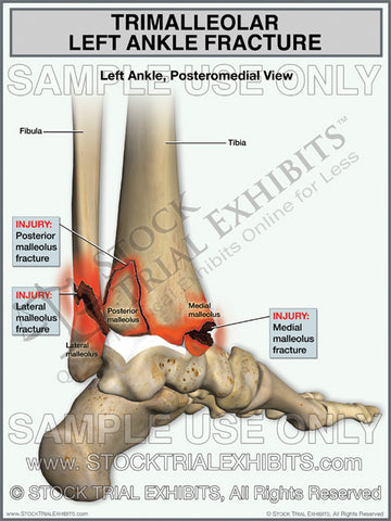 Trimalleolar Left Ankle Fracture