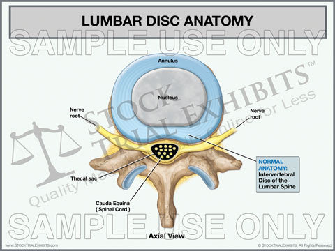 Lumbar Disc Anatomy Trial Exhibit (Axial View)