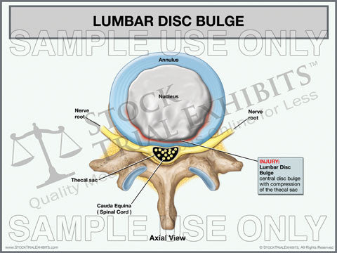 Lumbar Disc Bulge Trial Exhibit (Axial View)