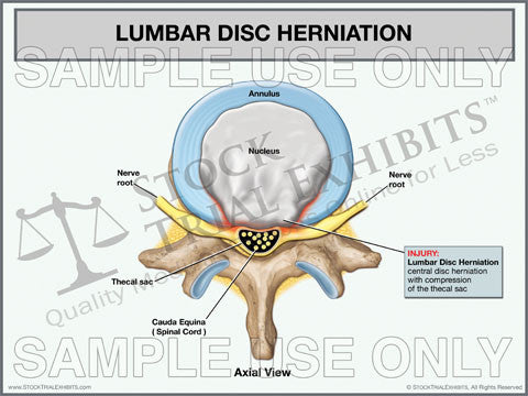 Lumbar Disc Herniation Trial Exhibit (Axial View)