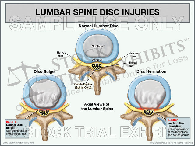 Lumbar Disc Injuries Trial Exhibit (Axial View)
