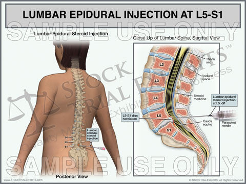 Lumbar Epidural Injection of L5-S1 Trial Exhibit (Female)