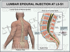 Lumbar Epidural Injection L5-S1 Male Trial Exhibit Lumbar Pain Management