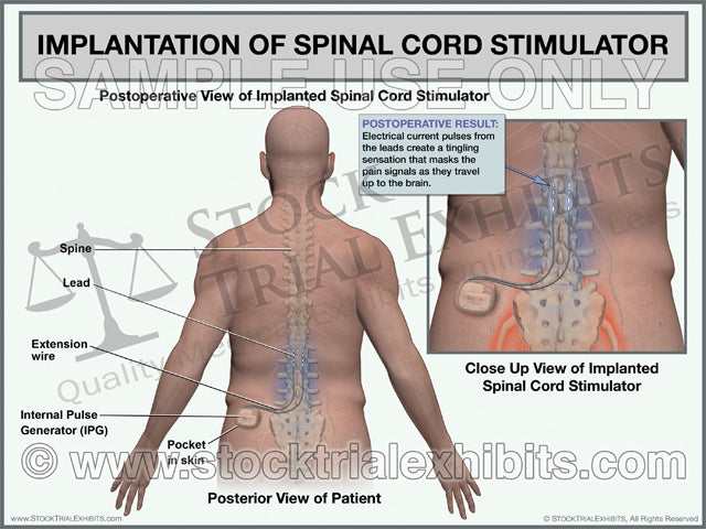 Spinal Cord Stimulator Trial Exhibit, Spinal Cord Stimulator, Implantation of Spinal Cord Stimulator