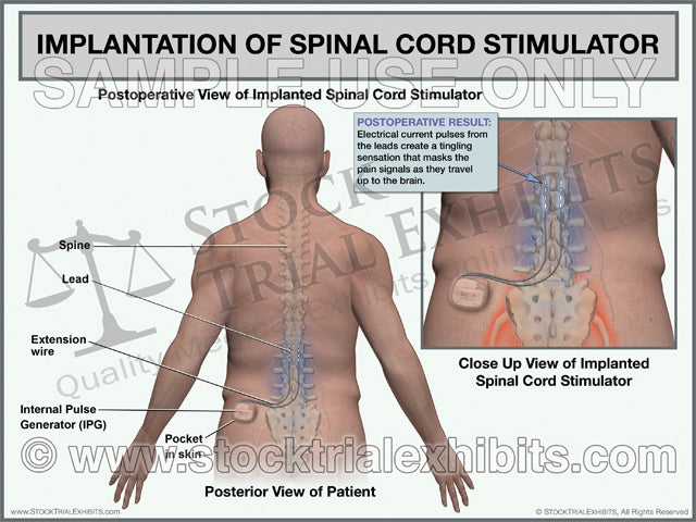 Spinal Cord Stimulator Trial Exhibit, Spinal Cord Stimulator, Implantation of Spinal Cord Stimulator