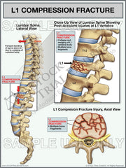 Lumbar Spine L1 Compression Fracture Trial Exhibit | 3 Views: Full Lateral, Close-Up Lateral & Axial | Stock Medical Illustration for Personal Injury Attorneys | Instant Download
