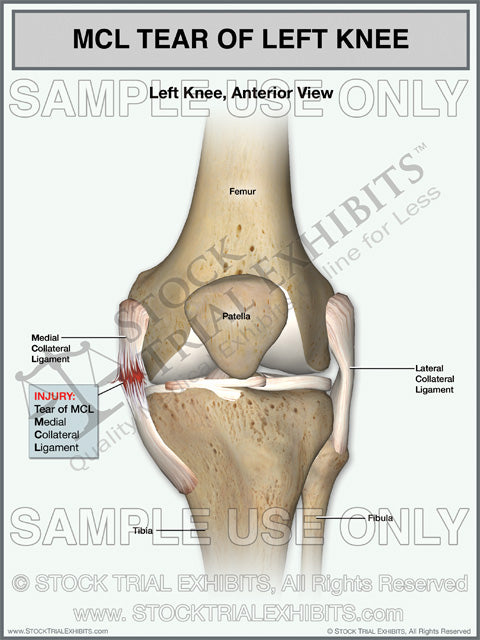 MCL Tear of the Left Knee – Stock Trial Exhibits