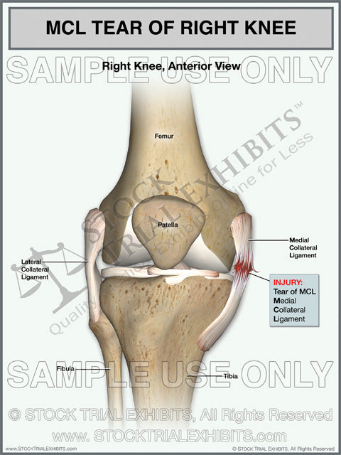 MCL Tear of the Right Knee – Stock Trial Exhibits