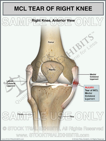 MCL Tear of the Right Knee