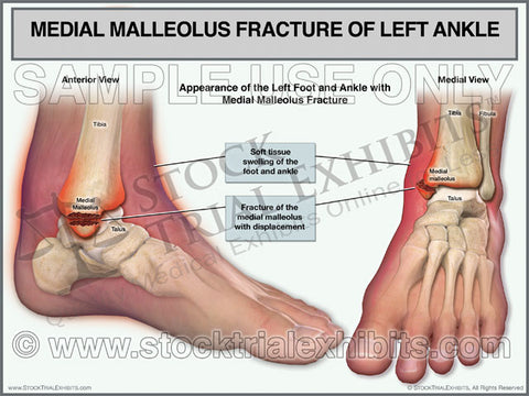 Medial Malleolus Fracture of the Left Ankle (two views)