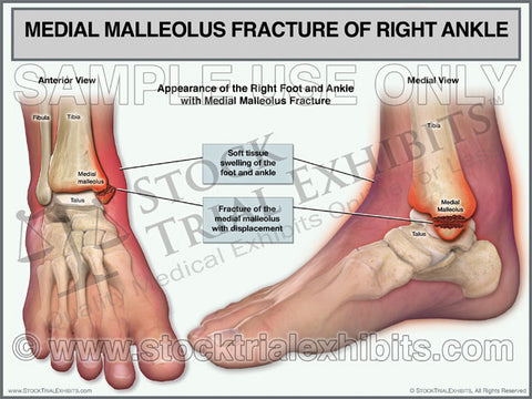 Medial Malleolus Fracture of the Right Ankle (two views)