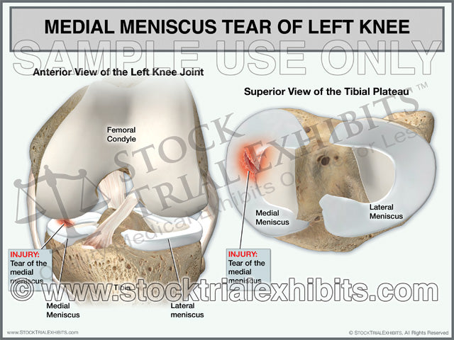 Medial Meniscus Tear of the Left Knee trial exhibit depicts a medial meniscus tear of the left knee. The medial meniscus injury is shown in the anterior view of knee joint with surrounding anatomy and superior view of the tibial plateau showing a close up view of the injury. 