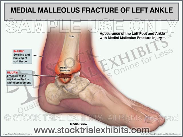 Medial Malleolus Fracture of the Left Ankle