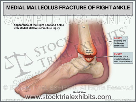 Medial Malleolus Fracture of the Right Ankle