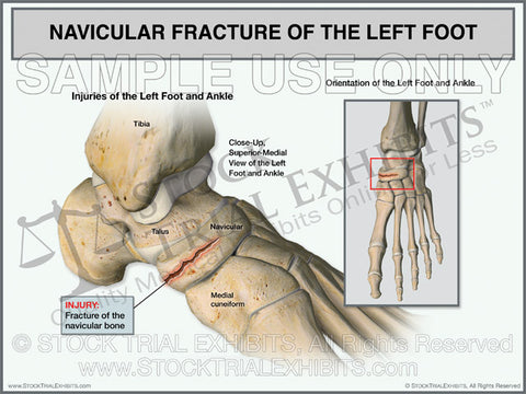 Navicular Fracture of the Left Foot