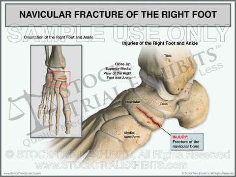 Navicular Fracture of the Right Foot