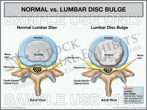 Normal Lumbar Disc vs. Lumbar Disc Bulge Trial Exhibit (Axial View)
