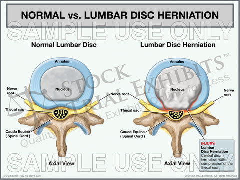 Normal Lumbar Disc vs. Lumbar Disc Herniation Trial Exhibit (Axial View)