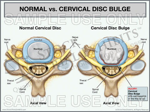 Normal Cervical Disc vs. Cervical Disc Bulge Trial Exhibit (Axial View)