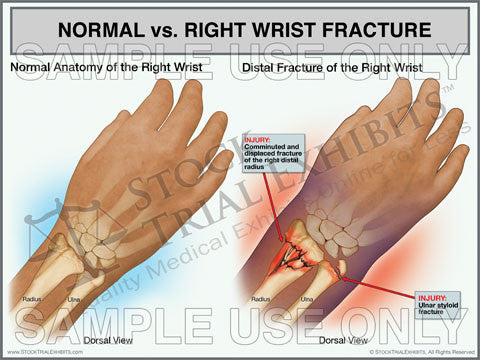 Normal Anatomy vs. Right Wrist Fracture Trial Exhibit