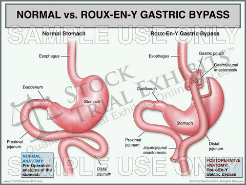 Normal Stomach vs. Roux En Y Gastric Bypass